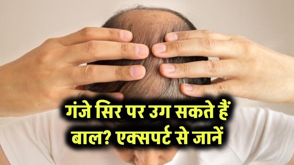 सिर पर दोबारा उग सकते हैं बाल? क्या सच में मुमकिन है हेयर रीग्रोथ एक्सपर्ट से जानिए 1 गंजे सिर पर उग सकते हैं बाल? एक्सपर्ट से जानें