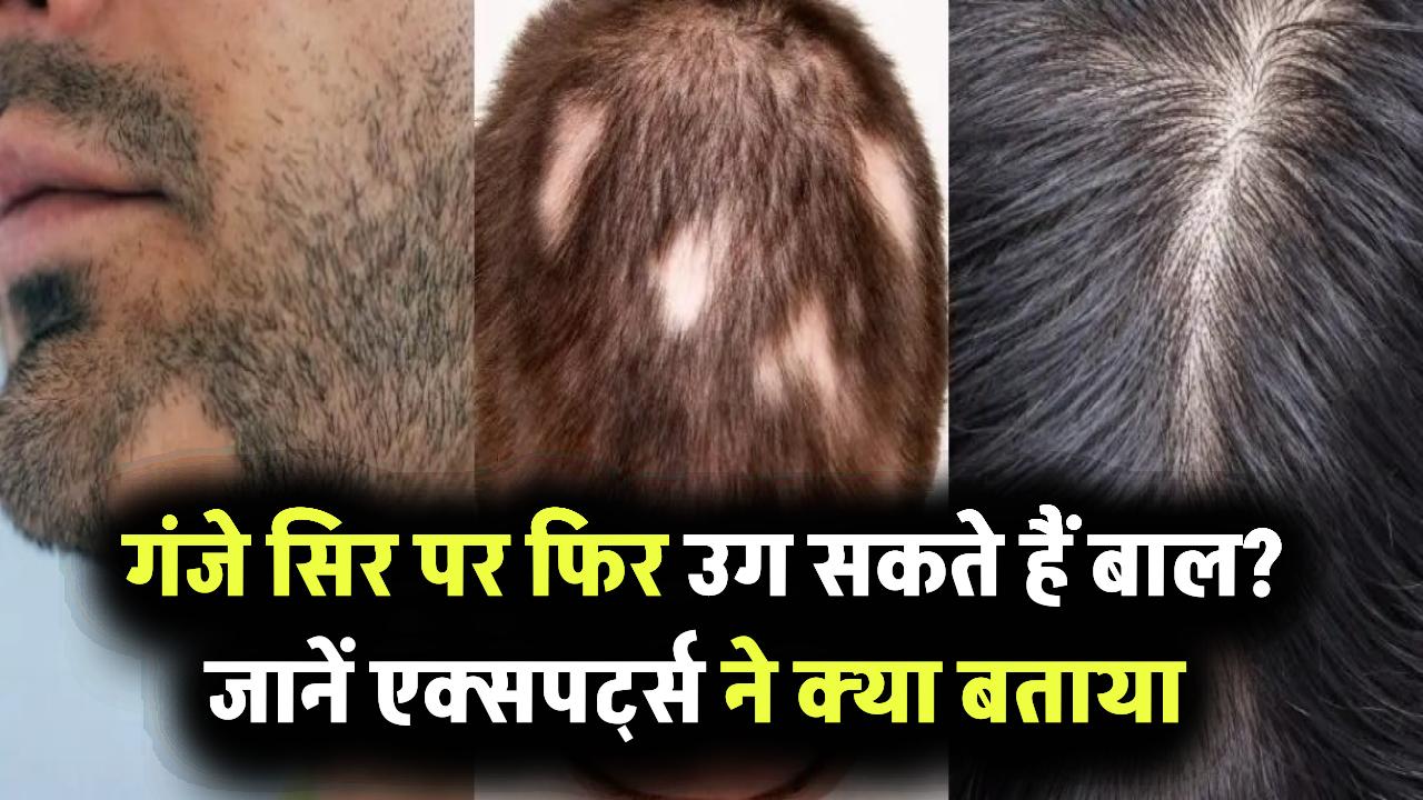 क्या गंजे सिर पर फिर उग सकते हैं बाल? एक्सपर्ट्स ने बताया